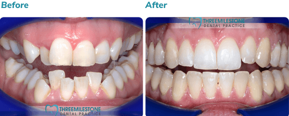 Before and after Invisalign result 1