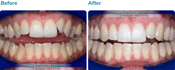 Before and after Invisalign result 2