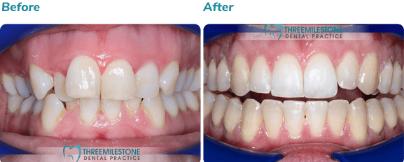 Before and after Invisalign result 3
