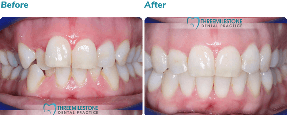 Before and after Invisalign result 4